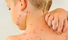 От кори умер еще один ребенок в Украине