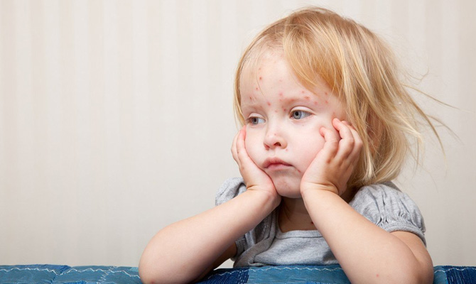 В Минздраве ожидают пик заболеваемости корью в начале марта