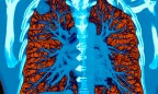 Искусственный интеллект от Google научился распознавать рак легких не хуже врачей