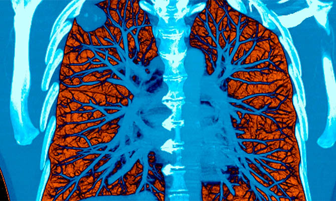 Искусственный интеллект от Google научился распознавать рак легких не хуже врачей