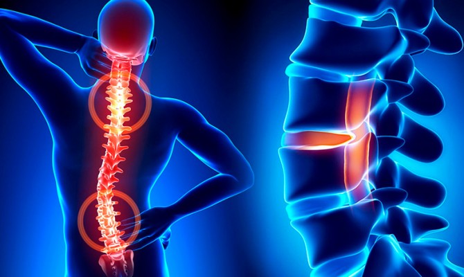 Остеохондроз грудного отдела позвоночника